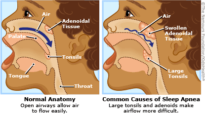 sleep apnea throat